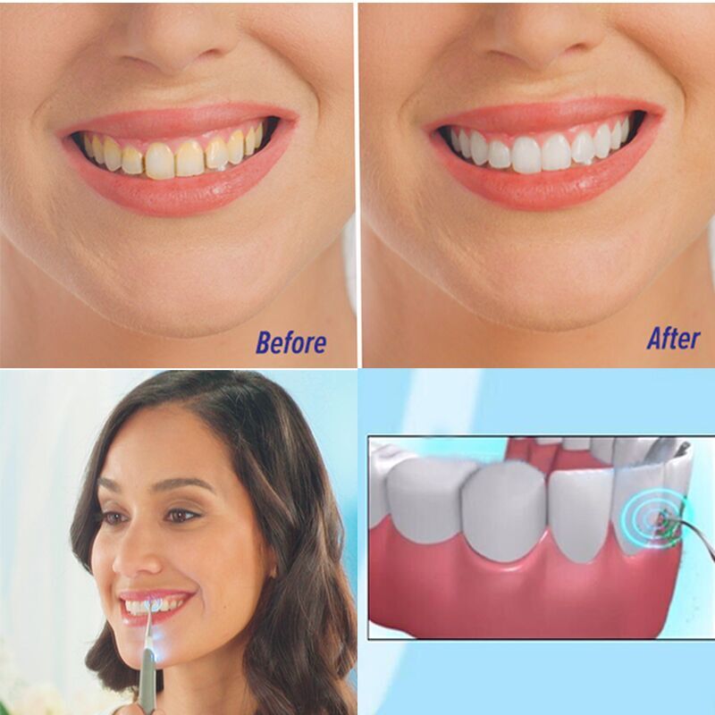 Sonic Dental Scaler Electric Polishing Teeth Whitening Oral Vibrating Remove Calculi